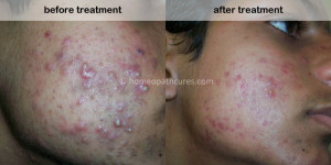 homeopathy treatment for acne