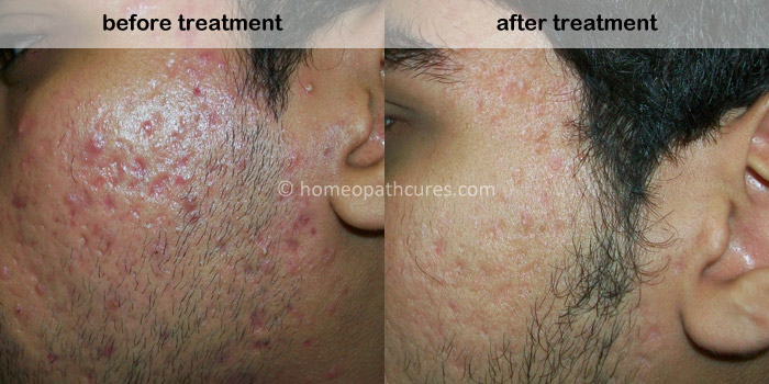 homeopathy treatment for acne