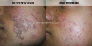 homeopathy treatment for acne