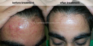 homeopathy treatment for acne vulgaris
