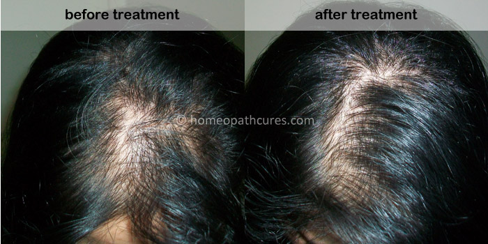 alopecia homeopathy treatment