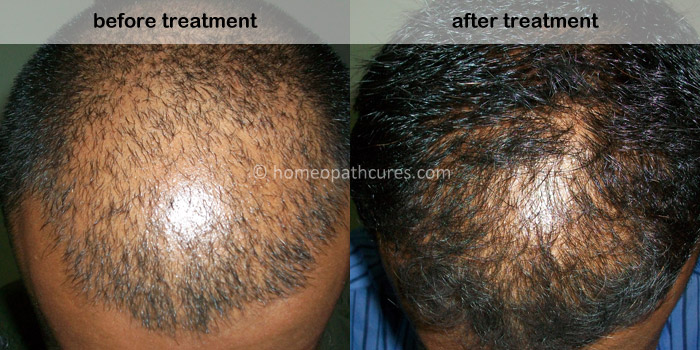 homeopathy treatment for alopecia