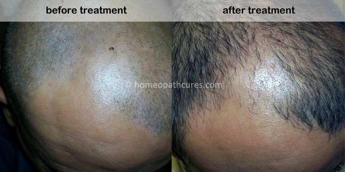 homeopathy treatment for alopecia