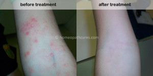 homeopathy treatment for Atopic Dermatitis