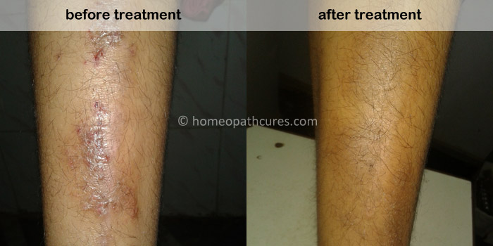 homeopathy treatment for Atopic Dermatitis