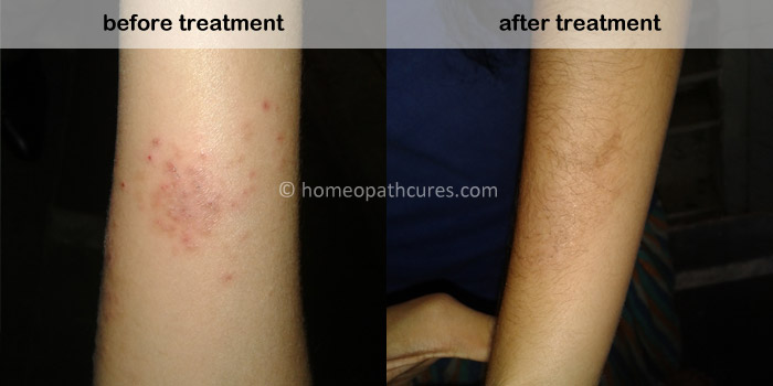 homeopathy treatment for Atopic Dermatitis
