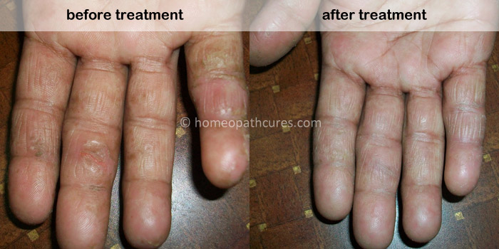 homeopathy treatment for eczema