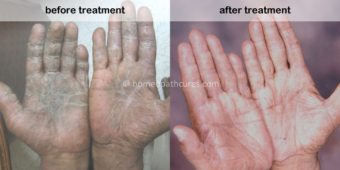 homeopathy treatment for eczema