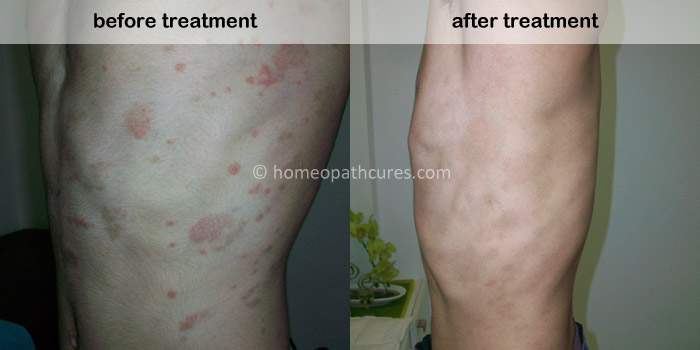 homeopathy treatment for psoriasis