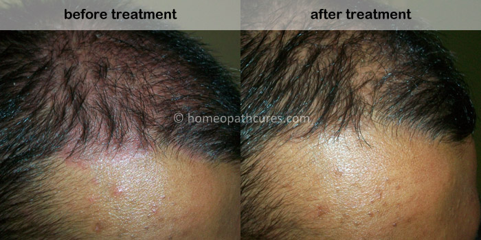 homeopathy treatment for scalp