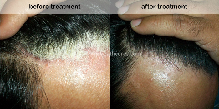 homeopathy treatment for scalp