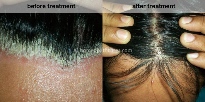 Homeopathic scalp treatment
